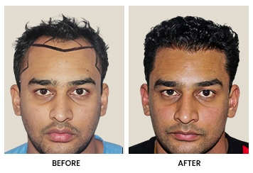 Customized Hair Transplant Tailored to Your Face